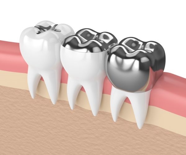 Options For Dental Crowns Material
