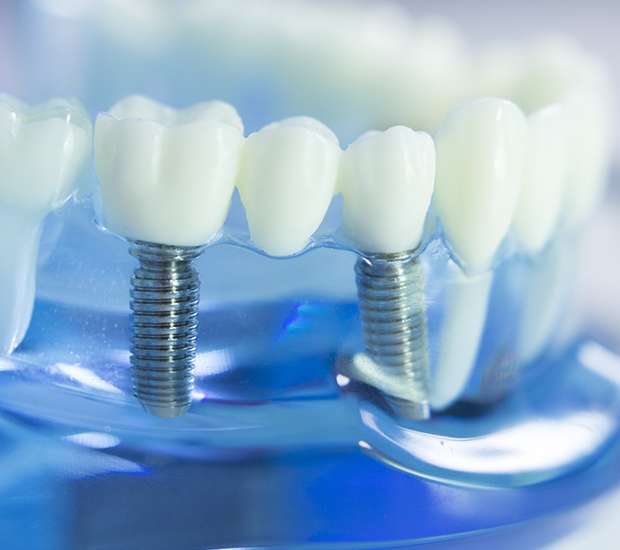 Rockville Centre Dental Implants